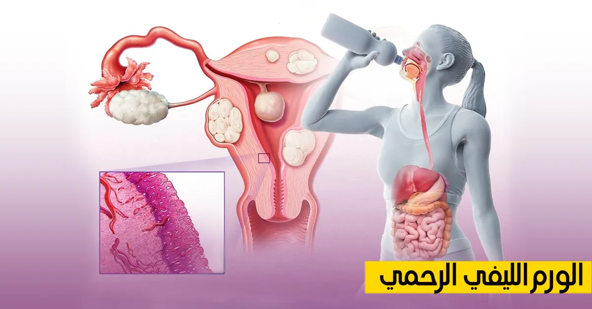 الورم الليفي الرحمي